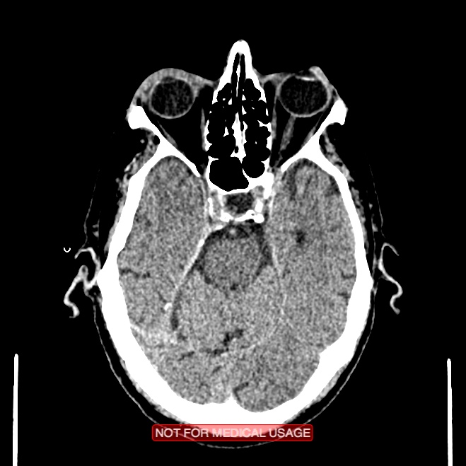 Artery of Percheron infarction (Radiopaedia 28679-28967 Axial non-contrast 40).jpg