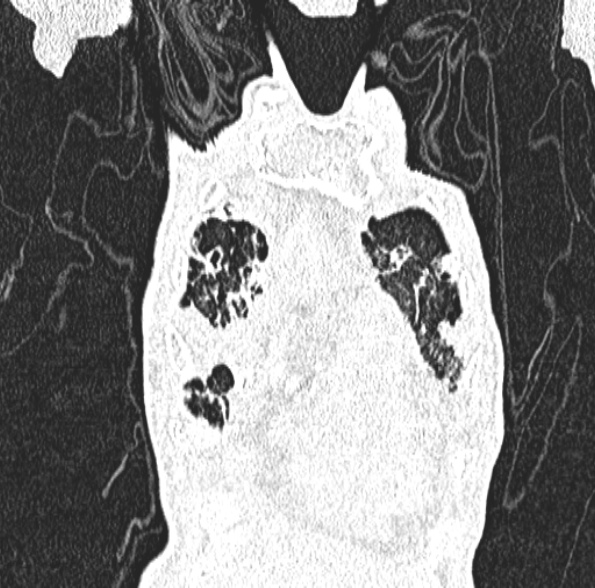 Aspergilloma- with Monod sign (Radiopaedia 44737-48532 Coronal lung window 136).jpg