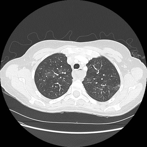 File:Aspiration pneumonia secondary to laparoscopic banding (Radiopaedia 18345-18183 lung window 23).jpg