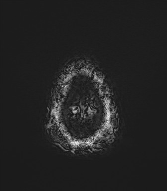 Astrocytoma (Radiopaedia 85660-101440 Axial SWI 84).jpg