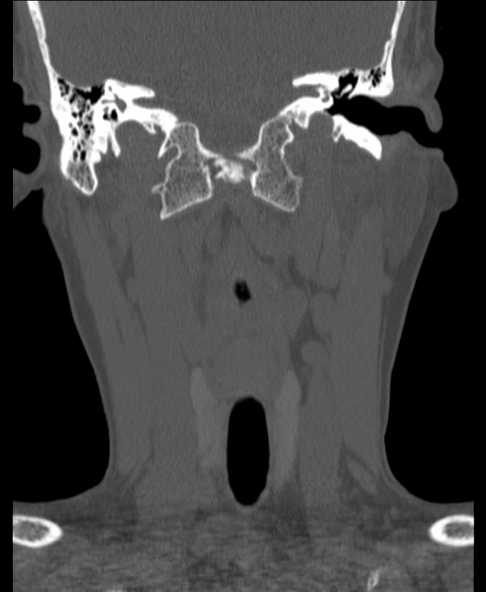 Atlanto-occipital assimilation with basilar invagination (Radiopaedia 70122-80188 Coronal bone window 52).jpg