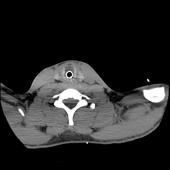 File:Atlanto-occipital dissociation (Traynelis type 1), C2 teardrop fracture, C6-7 facet joint dislocation (Radiopaedia 87655-104061 Axial non-contrast 69).jpg