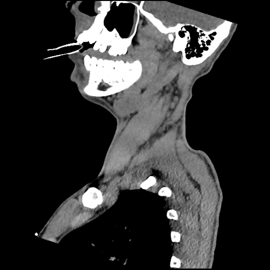 Atlanto-occipital dissociation (Traynelis type 1), C2 teardrop fracture, C6-7 facet joint dislocation (Radiopaedia 87655-104061 D 22).jpg