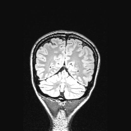 File:Atretic encephalocoele with inferior vermis hypoplasia (Radiopaedia 30443-31108 Coronal FLAIR 47).jpg