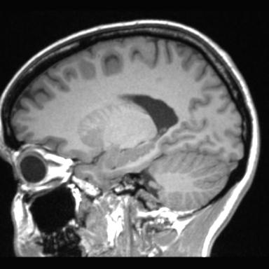 Atretic encephalocoele with inferior vermis hypoplasia (Radiopaedia 30443-31108 Sagittal T1 46).jpg