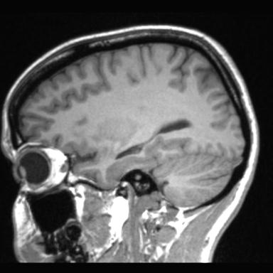 Atretic encephalocoele with inferior vermis hypoplasia (Radiopaedia 30443-31108 Sagittal T1 94).jpg