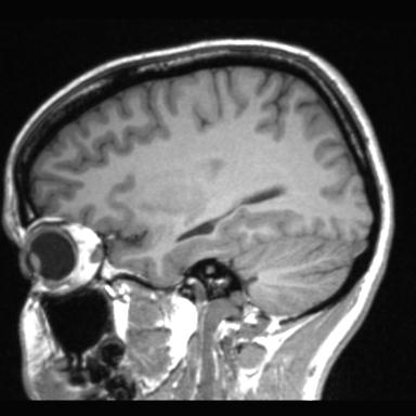 File:Atretic encephalocoele with inferior vermis hypoplasia (Radiopaedia 30443-31108 Sagittal T1 95).jpg
