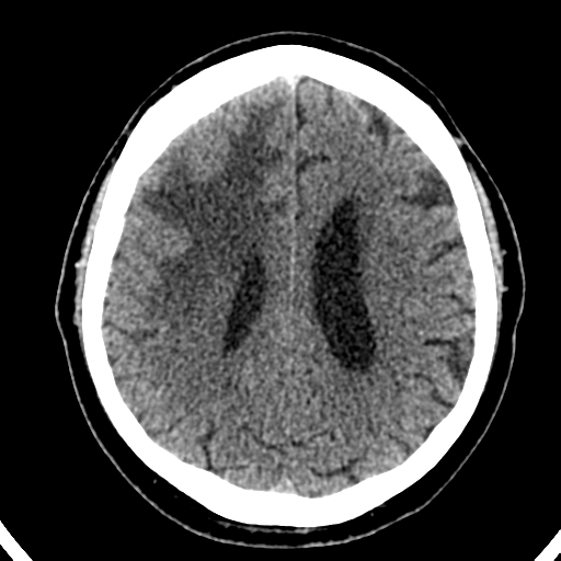 File:Atypical meningioma (WHO grade II) with brain invasion (Radiopaedia 57767-64728 Axial non-contrast 29).png