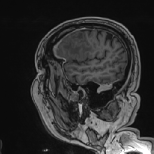 Atypical meningioma (WHO grade II) with brain invasion (Radiopaedia 57767-64729 Sagittal T1 C+ 53).png