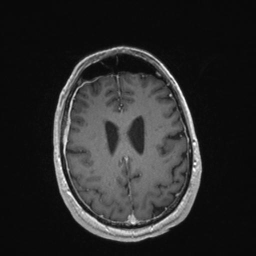Atypical meningioma (grade II) - en plaque (Radiopaedia 29633-30147 Axial T1 C+ 131).jpg