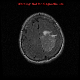 File:Atypical meningioma - grade II (Radiopaedia 13303-13305 Axial FLAIR 18).jpg