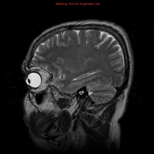 File:Atypical meningioma - grade II (Radiopaedia 13303-13305 Sagittal T2 17).jpg