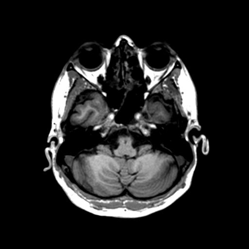Autoimmune limbic encephalitis (Radiopaedia 30363-31005 T1 Axial 1mm 38).jpg