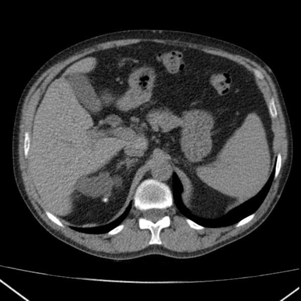 File:Autosomal dominant polycystic kidney disease (Radiopaedia 36539-38101 Axial non-contrast 22).jpg
