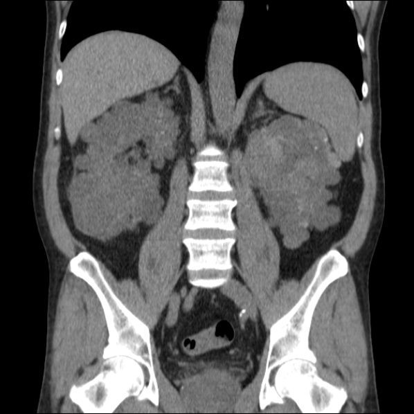 File:Autosomal dominant polycystic kidney disease (Radiopaedia 36539-38101 C 43).jpg