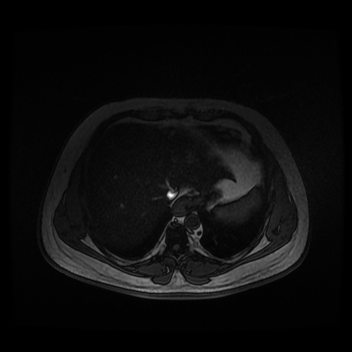 File:Autosomal dominant polycystic kidney disease (Radiopaedia 50259-55611 Axial 2D Dual Echo 13).jpg