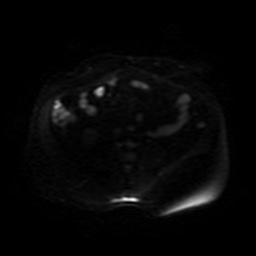 File:Autosomal dominant polycystic kidney disease (Radiopaedia 50259-55611 Axial DWI 36).jpg