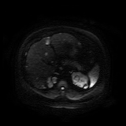Autosomal dominant polycystic kidney disease (Radiopaedia 50259-55611 Axial DWI 87).jpg