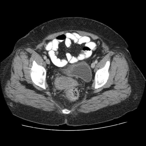 File:Autosomal dominant polycystic kidney disease with hepatic involvement (Radiopaedia 32693-33662 B 74).jpg