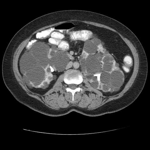 Autosomal dominant polycystic kidney disease with hepatic involvement (Radiopaedia 32693-33662 C 38).jpg