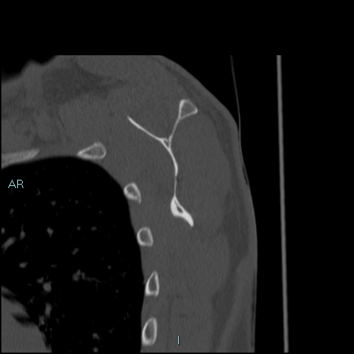 Avascular necrosis after fracture dislocations of the proximal humerus (Radiopaedia 88078-104653 Sagittal bone window 56).jpg