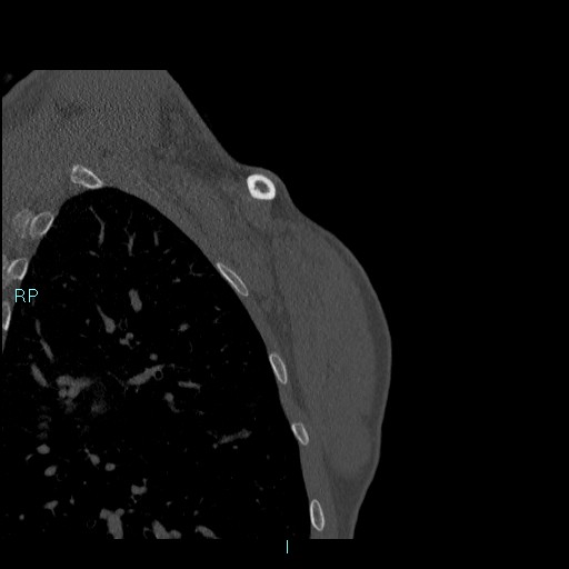 Avascular necrosis after fracture dislocations of the proximal humerus (Radiopaedia 88078-104655 Coronal bone window 138).jpg
