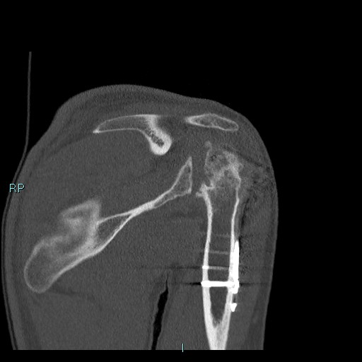 Avascular necrosis after fracture dislocations of the proximal humerus (Radiopaedia 88078-104655 Coronal bone window 64).jpg
