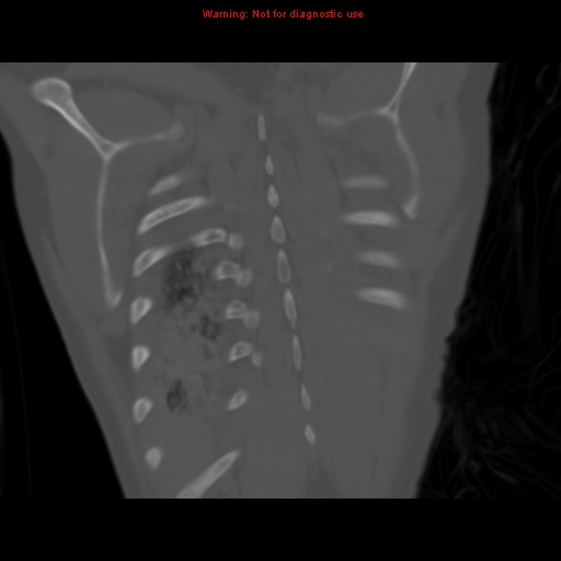 Avascular necrosis in sickle cell disease (Radiopaedia 17448-17152 Coronal bone window 112).jpg