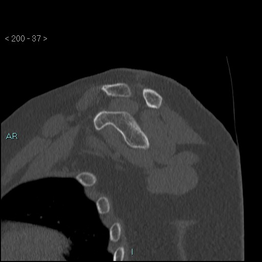File:Avascular necrosis of the shoulder - Cruess stage I (Radiopaedia 77674-89887 Sagittal bone window 36).jpg