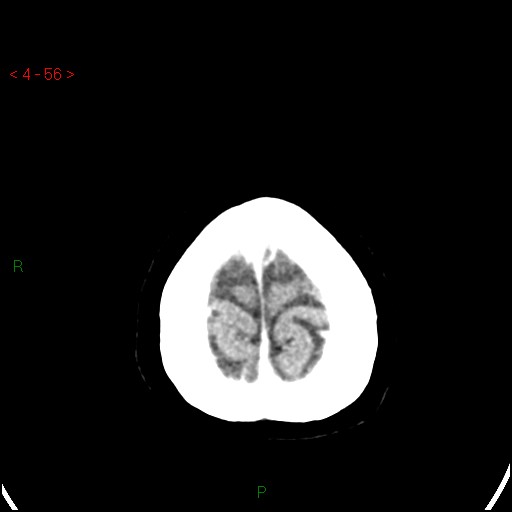 Azygos anterior cerebral artery (Radiopaedia 51987-57833 A 56).jpg
