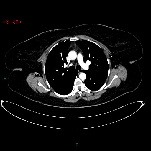 Azygos fissure and lobe (Radiopaedia 47620-52278 A 75).jpg