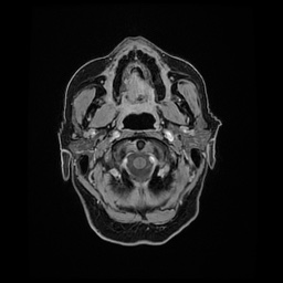 Balo concentric sclerosis (Radiopaedia 53875-59982 Axial LAVA C+ 19).jpg