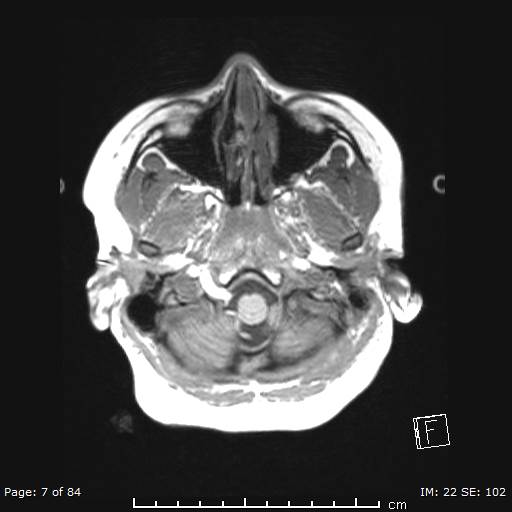Balo concentric sclerosis (Radiopaedia 61637-69636 Axial T1 7).jpg