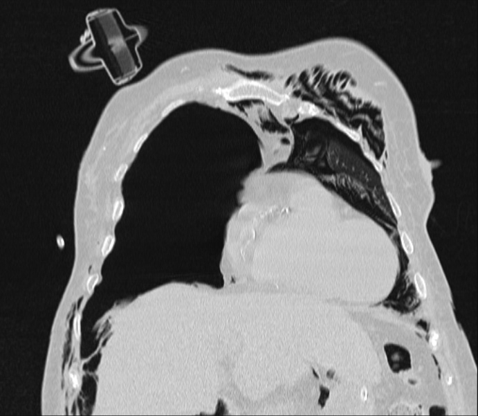 Barotrauma due to mechanical ventilation (Radiopaedia 28079-28336 Coronal lung window 30).jpg