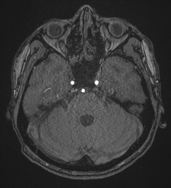 Basal ganglia subacute infarct (Radiopaedia 80201-93521 Axial MRA 25).png