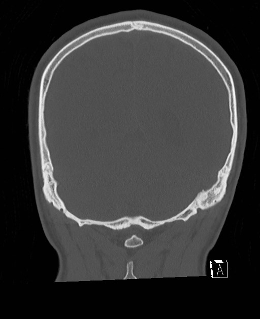 Base of skull fracture with bilateral Le Fort fractures (Radiopaedia 47094-51638 Coronal bone window 25).jpg