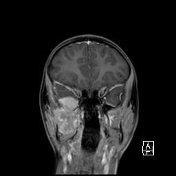 Base of skull rhabdomyosarcoma (Radiopaedia 32196-33142 I 27).jpg