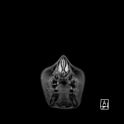 Base of skull rhabdomyosarcoma (Radiopaedia 32196-33142 I 8).jpg