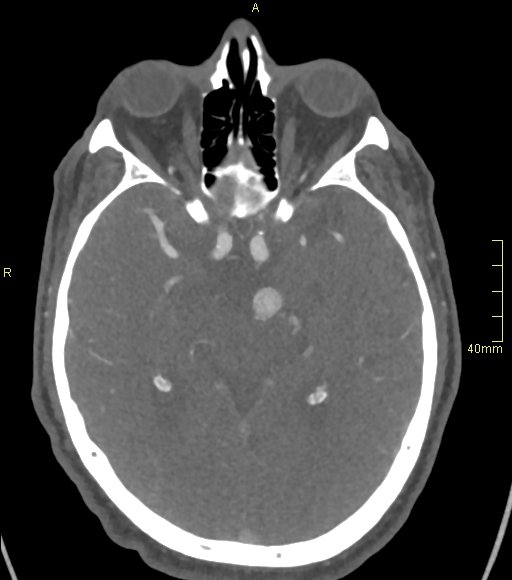 Basilar artery aneurysm (Radiopaedia 56261-62932 A 73).jpg