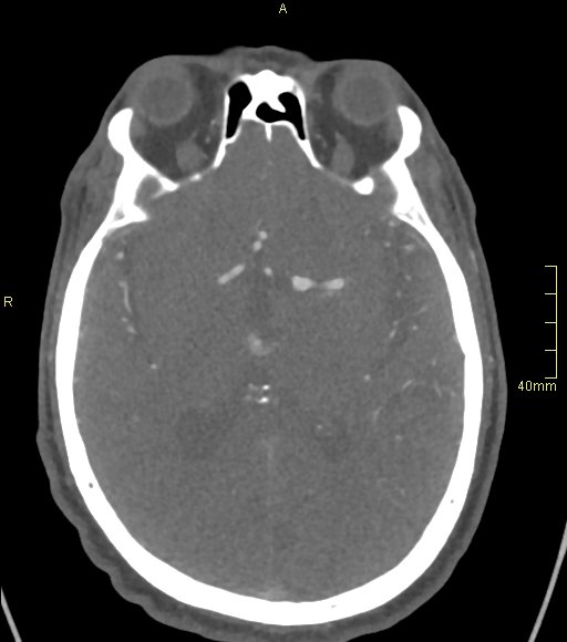 Basilar artery aneurysm (Radiopaedia 56261-62932 A 82).jpg