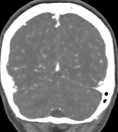 Basilar tip aneurysm with coiling (Radiopaedia 53912-60086 B 126).jpg