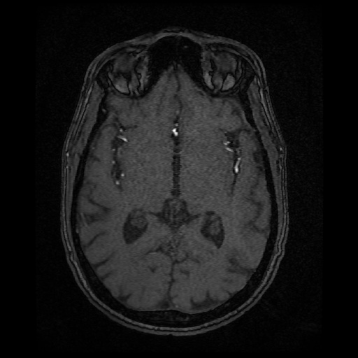 Basilar top and left middle cerebral artery aneurysm (Radiopaedia 61965-70031 Axial MRA 80).jpg