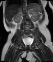 File:Beckwith-Wiedeman syndrome with bilateral Wilms tumors (Radiopaedia 60850-69233 Coronal T2 11).jpg