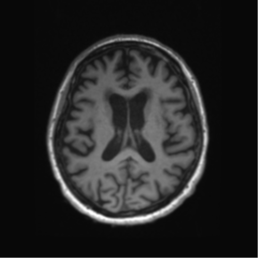File:Behavioral variant frontotemporal dementia and late onset schizophrenia (Radiopaedia 52197-58083 Axial T1 39).png