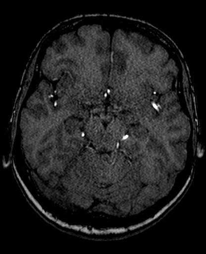 File:Berry aneurysm of the terminal internal carotid artery (Radiopaedia 88286-104918 Axial TOF 106).jpg