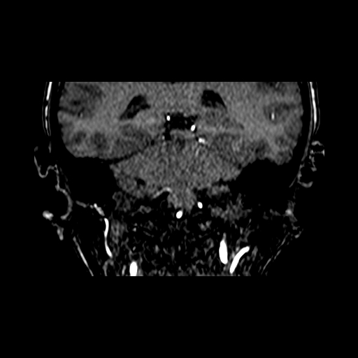 Berry aneurysm of the terminal internal carotid artery (Radiopaedia 88286-104918 Coronal TOF 70).jpg