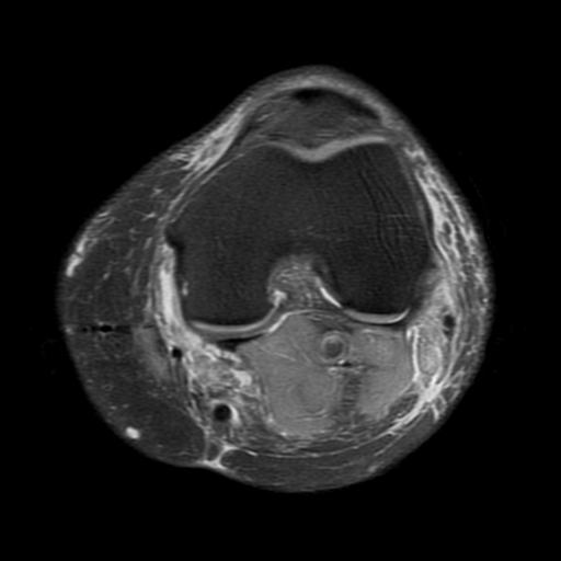 File:Biceps femoris distal tendon avulsion (Radiopaedia 15109-14987 Axial PD fat sat 11).jpg