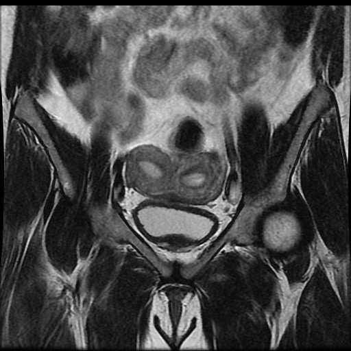 File:Bicornuate uterus (Radiopaedia 51676-57472 Coronal T2 10).jpg