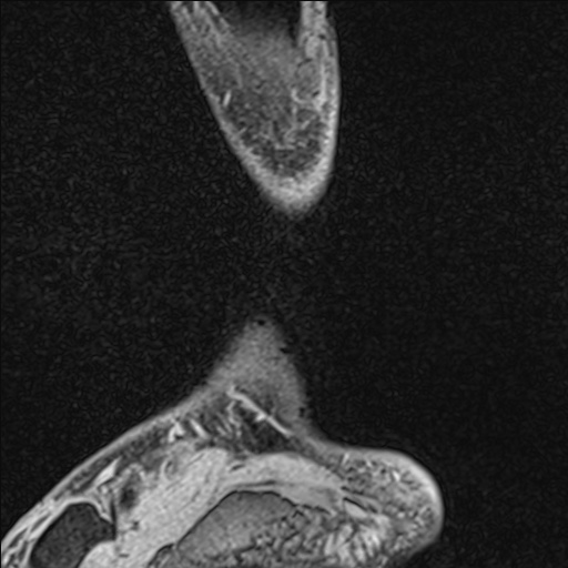 File:Bilateral Achilles tendon complete tear (Radiopaedia 81344-95051 Sagittal WE - Left 22).jpg