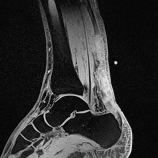 Bilateral Achilles tendon complete tear (Radiopaedia 81344-95051 Sagittal WE - Left 53).jpg